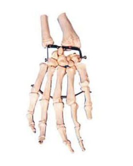 Palm Bone with Elbow-bone and Radial Bone Model AM-11125