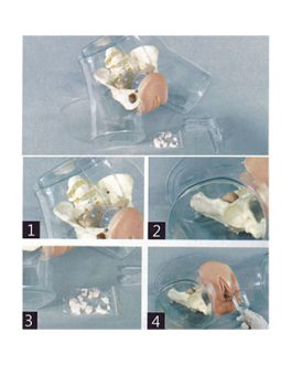Transparent Curettage Model AM-T32