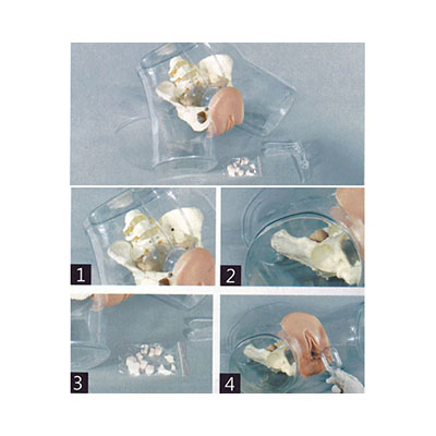 Transparent Curettage Model AM-T32